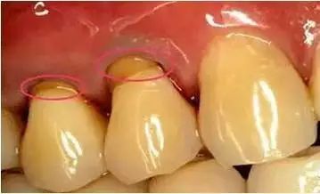 您在生活中会偶然间发现牙齿靠近牙龈的位置有 小沟沟?