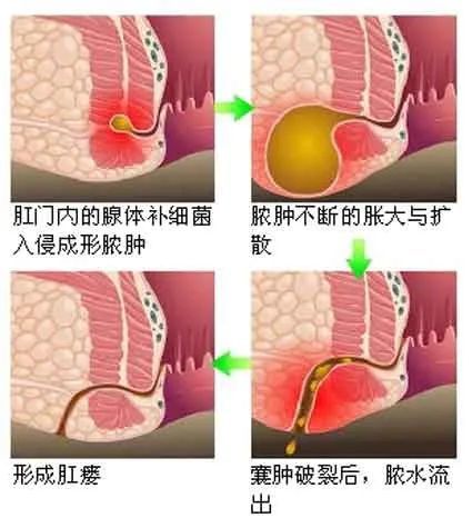 小儿肛瘘的症状图片图片