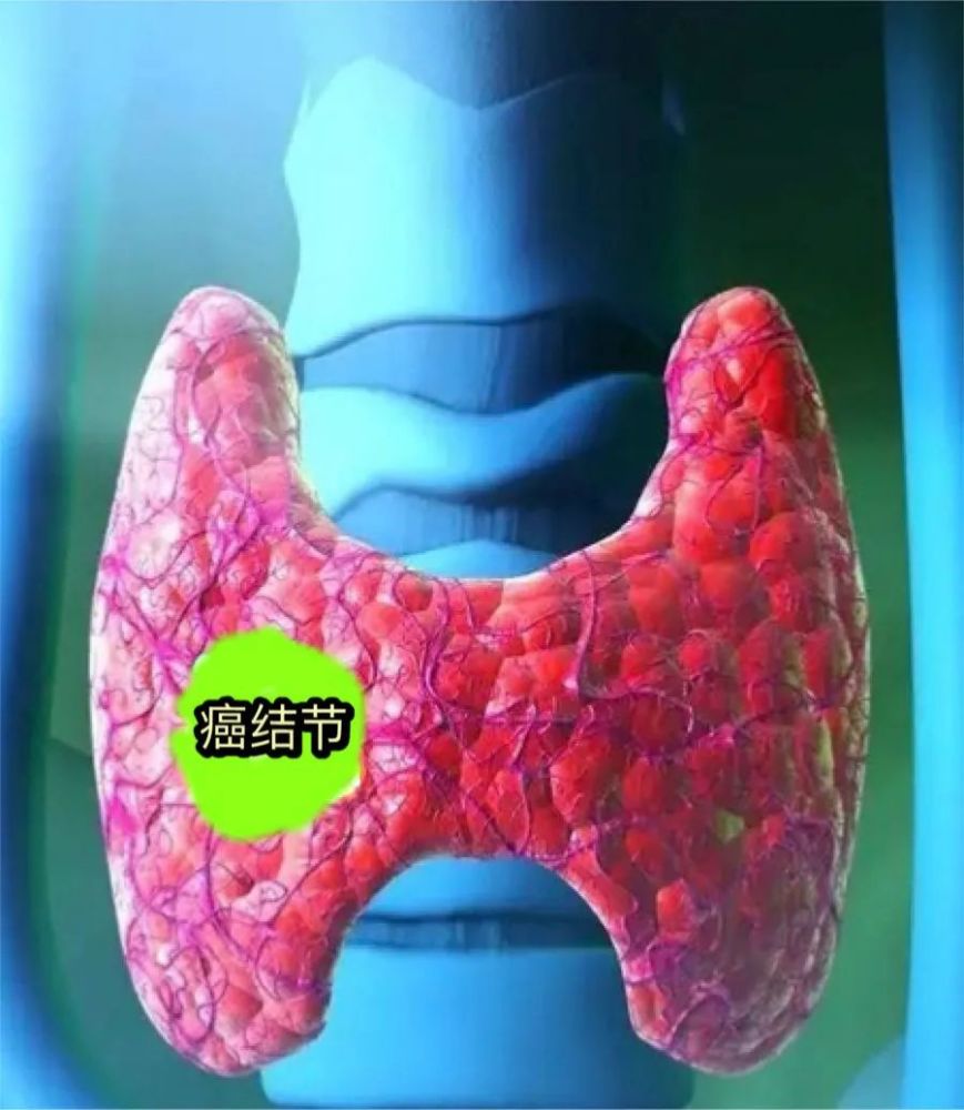 如果不即时采取措施,甲状腺癌结节一旦突破甲状腺被膜,不仅影响甲状腺