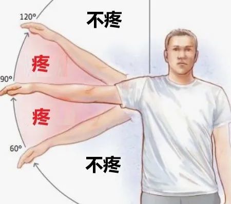 肩痛角度范围 | physio-pedia肩峰下间隙内有肌腱,韧带及肩峰下滑囊等