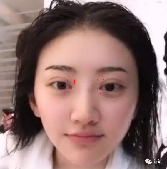 景甜大方说自己do了!做埋线双眼皮结果做成悲伤蛙