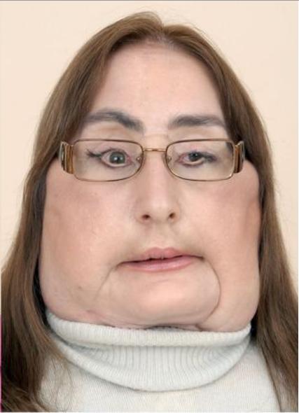 美国_社会|美国女子在丈夫的自杀中面部受伤，成全球面部移植第一人，现去世