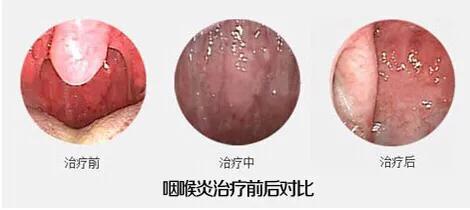 由于病情迁延造成的一种症状,慢性咽炎,目前不