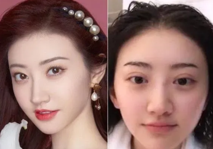 景甜大胆自曝割双眼皮经历医生用力过猛翻车一不小心变成蛤蟆眼睛