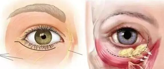 眶隔脂肪释放术缺点可弥补眶隔脂肪释放术成功率原来这样做会提高