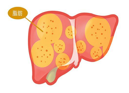 专家王安生表示:脂肪肝的症状有这些症状,建议自查一下