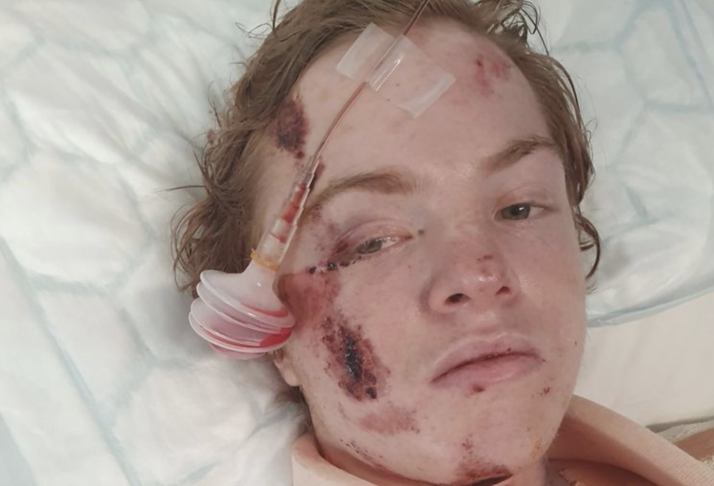 马路|英国16岁少年戴耳机过马路被撞成重伤，脑袋被撞个大洞奇迹生还