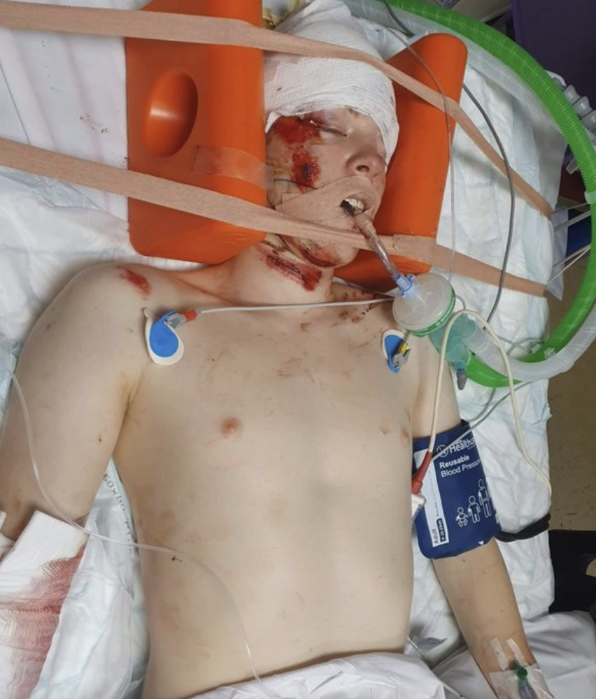 马路|英国16岁少年戴耳机过马路被撞成重伤，脑袋被撞个大洞奇迹生还