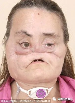 美国_社会|美国首例换脸人去世：丈夫之前家暴是种预示，不该心怀侥幸