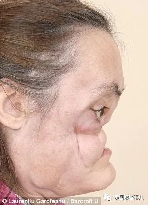 美国_社会|美国首例换脸人去世：丈夫之前家暴是种预示，不该心怀侥幸