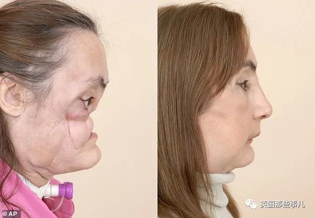 美国_社会|美国首例换脸人去世：丈夫之前家暴是种预示，不该心怀侥幸