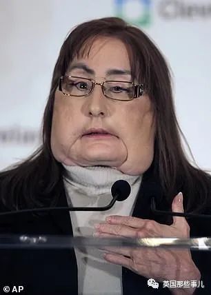 美国_社会|美国首例换脸人去世：丈夫之前家暴是种预示，不该心怀侥幸