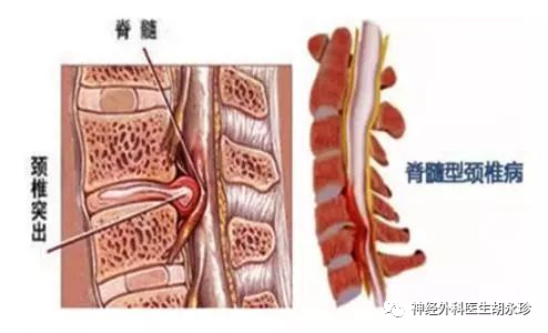 需要手术的颈椎病 脊髓型颈椎病 腾讯新闻