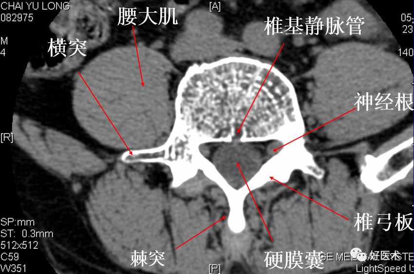 脊柱影像解剖及診斷要點