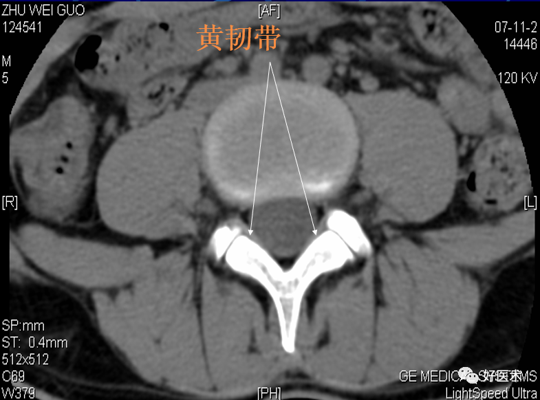 脊柱影像解剖及诊断要点