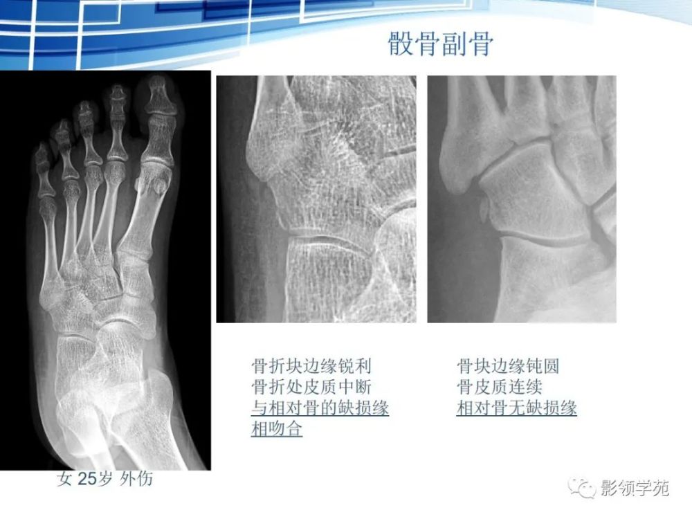 骨常见变异与撕脱骨折鉴别诊断 腾讯新闻