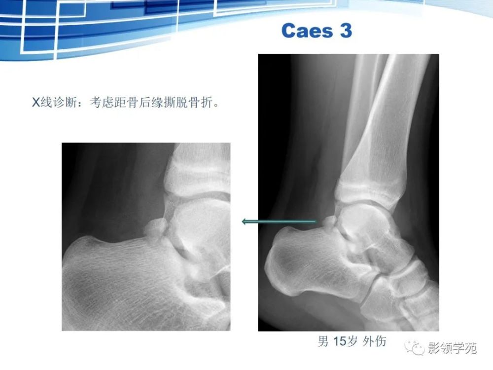 骨常见变异与撕脱骨折鉴别诊断 腾讯新闻