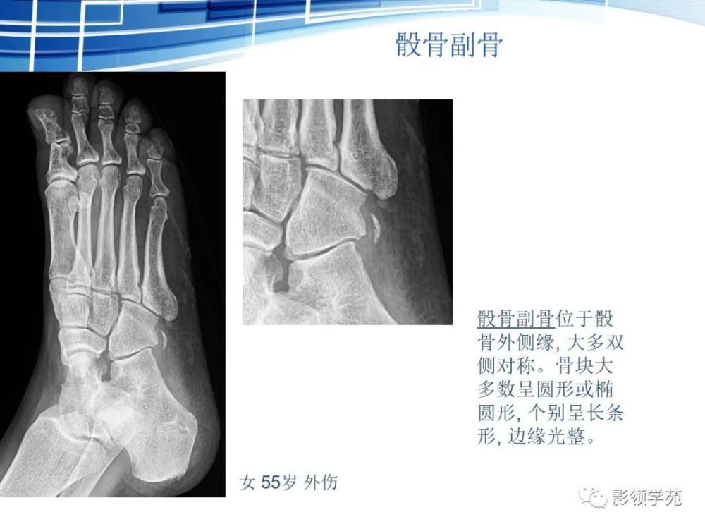 骨常见变异与撕脱骨折鉴别诊断 腾讯新闻