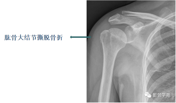 骨常见变异与撕脱骨折鉴别诊断 腾讯新闻