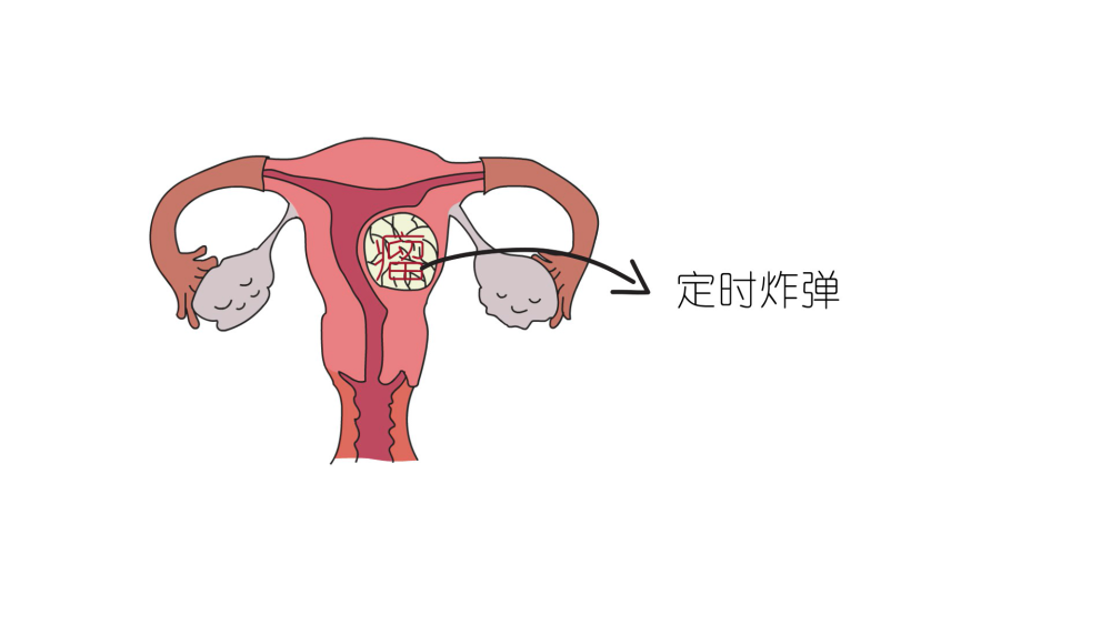 陪同着女性生儿育女的 定时炸弹 这 妇科第一瘤 有多恐怖 后宫王女人网