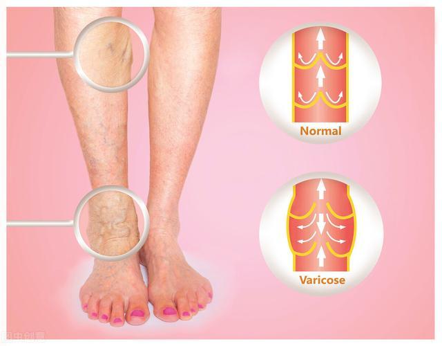 下肢深静脉血栓如何护理 从5个方面来着手 腾讯新闻