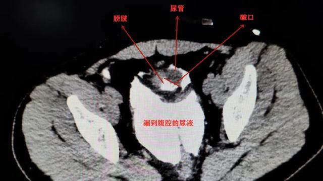 膀胱|憋尿会憋“死”人？真的！