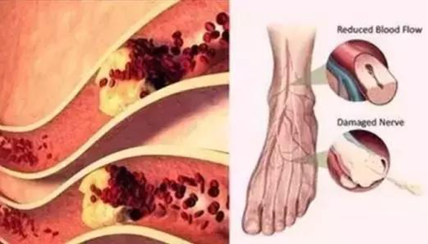 缺血|截肢并非唯一手段，干细胞有望改写严重下肢缺血治疗困局