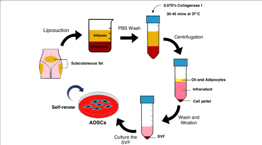 缺血|截肢并非唯一手段，干细胞有望改写严重下肢缺血治疗困局