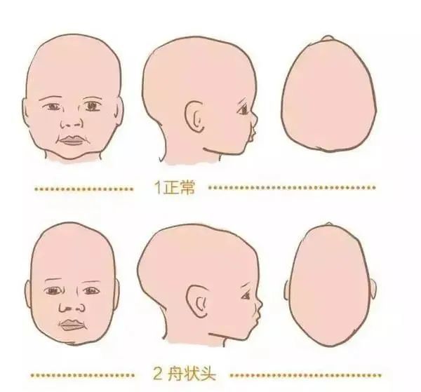 此外,颅骨早闭造,特别是矢状缝早闭,会使宝宝的头颅变长变窄,形成被称