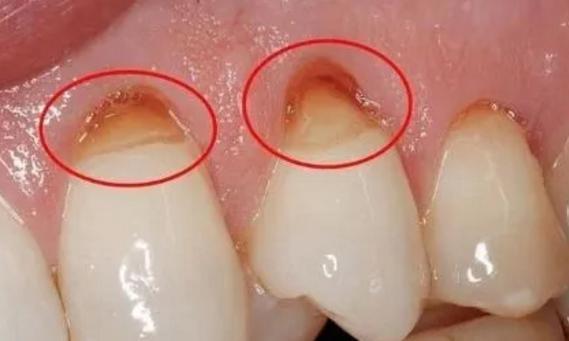 牙釉质损坏了怎样恢复图片