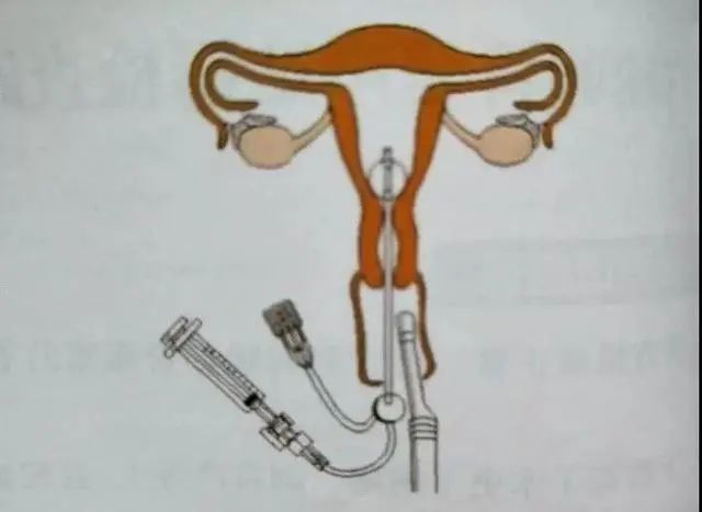 子宫输卵管超声造影——看看您的输卵管是否依然美丽?