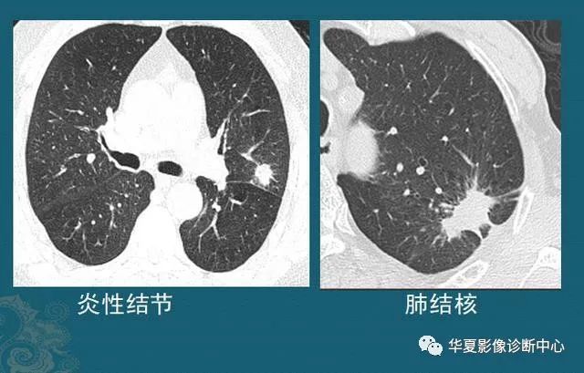 肺結節是怎麼長出來的?醫生教你看ct片,有2種可能是肺癌