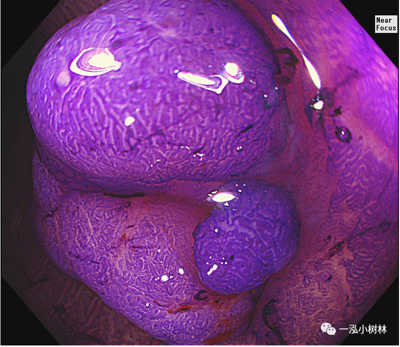 乙状结肠腺瘤图片图片