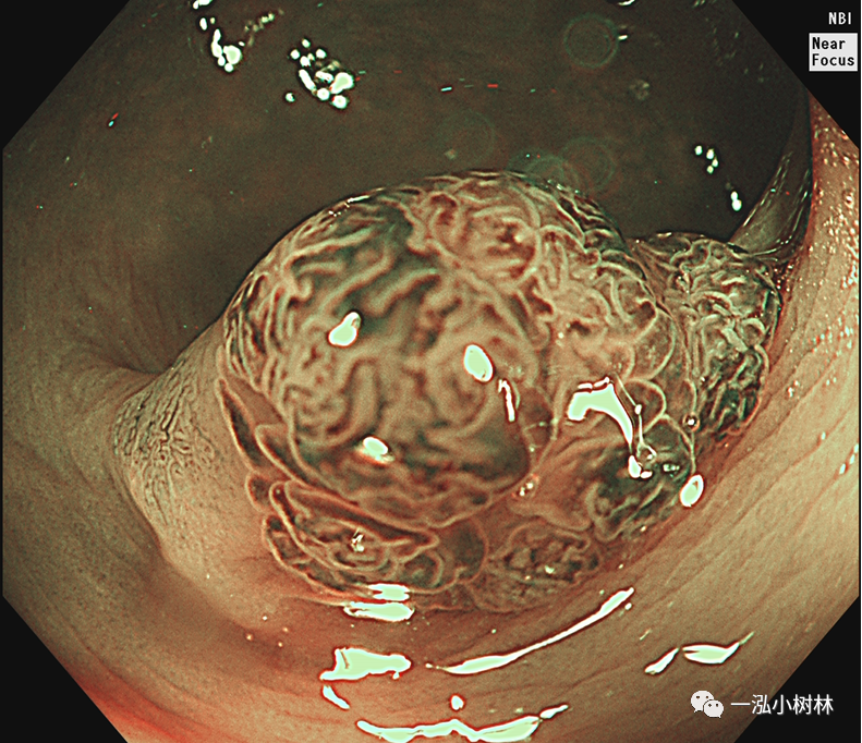t1期结直肠癌esd治疗