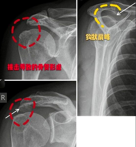 关节使劲甩动的的时候就有可能发生肩关节肩峰与肱骨大结节之间的撞击