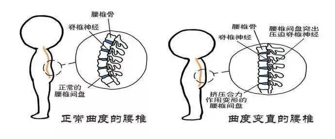 腰椎生理曲度变直有多可怕 如何科学有效防治 腾讯新闻