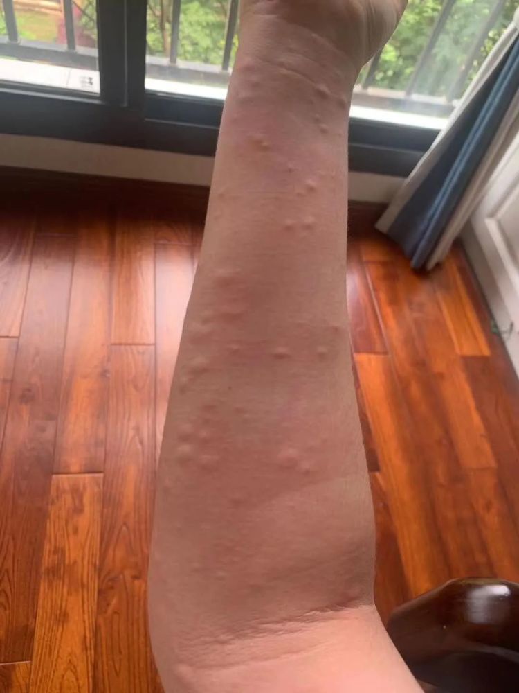 什么"幺蛾子"?合肥一小区百余居民起红疹!出门遛个弯就"中招"!