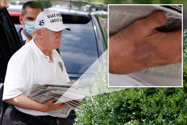 唐纳德·特朗普|特朗普右手现大片瘀伤，坊间猜测他在秘密治病