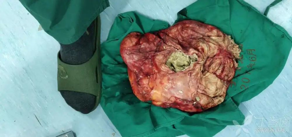 体检发现右侧腹巨大肿块,术中竟掏出一坨"麻酱"样物体……_腾讯新闻
