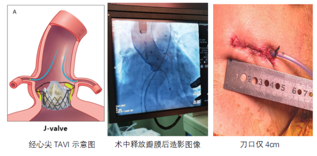 85岁垂危老人重获心生哈医大一院完成全省首例经心尖tavi手术