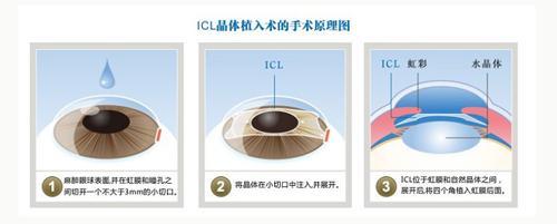 高度近视 别慌 Icl晶体植入来帮你 腾讯新闻