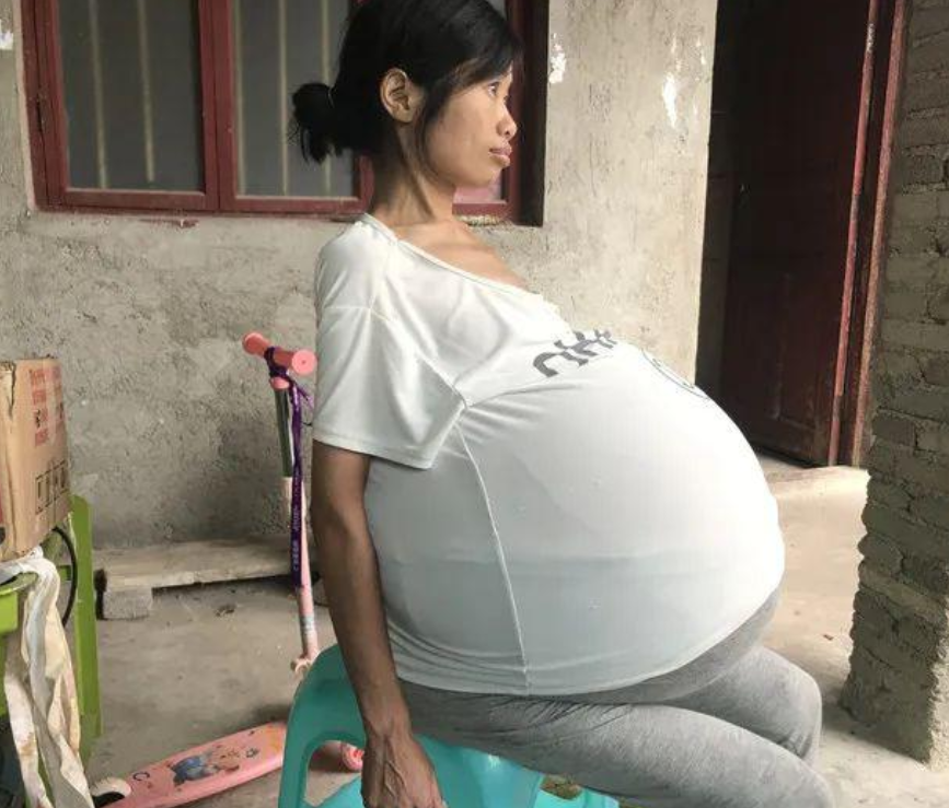 贵州女子身患多种疾病肚大如球10岁儿子撑起家希望我妈妈像正常人