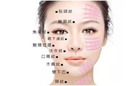 面部线雕多久可以消肿线雕术一周后肿胀消退有妙招
