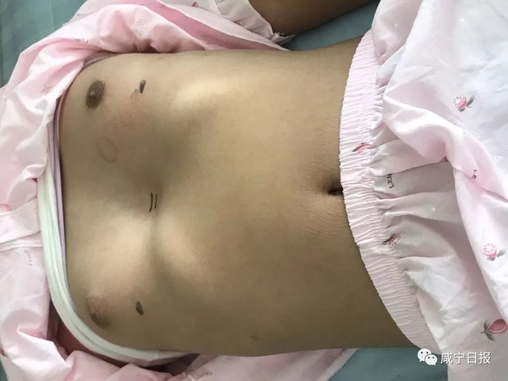 孩子胸部凹陷如漏斗这是怎么回事