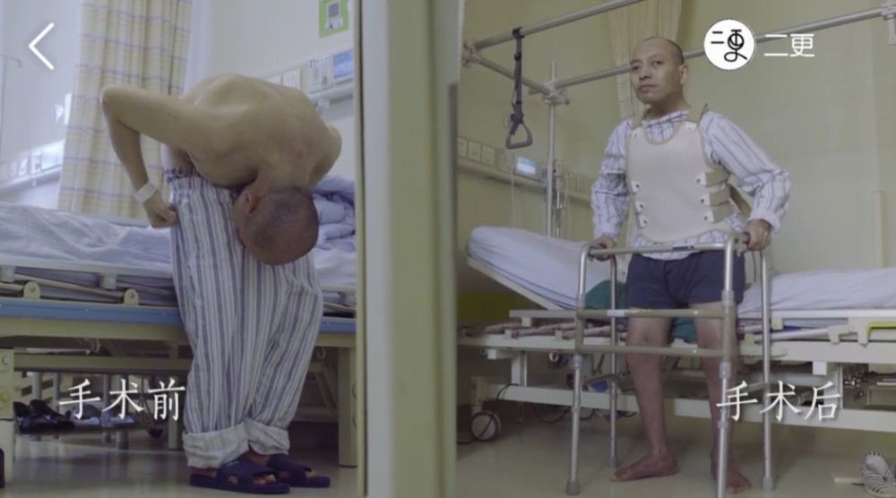 国内首例"3-on折叠人"李华终于打开了他26年的折叠人生,多年不能站