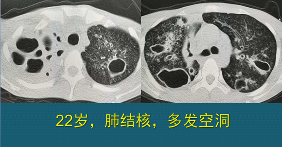 肺结核 肺部ct图片