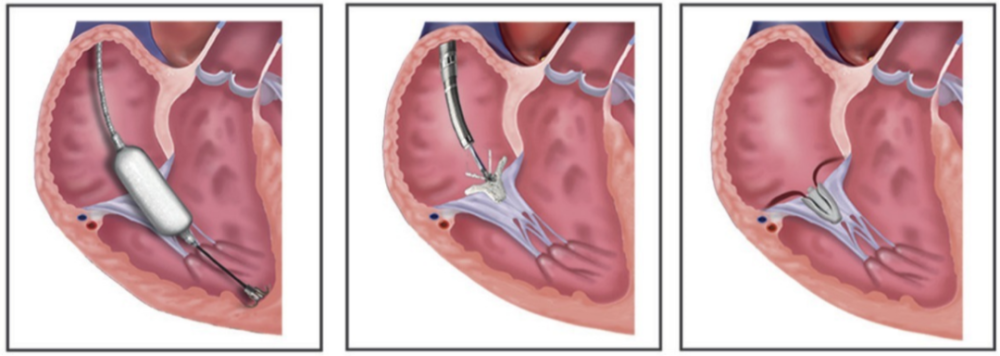 三尖瓣病变迎来介入治疗时代