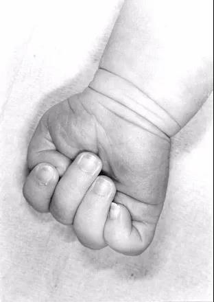 拇指内收是怎么回事?