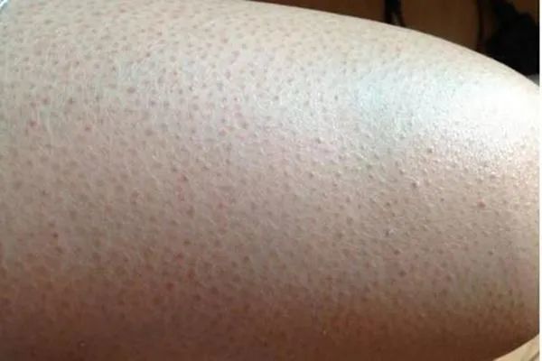 "起的鸡皮疙瘩"会不会变成"鸡皮肤"?