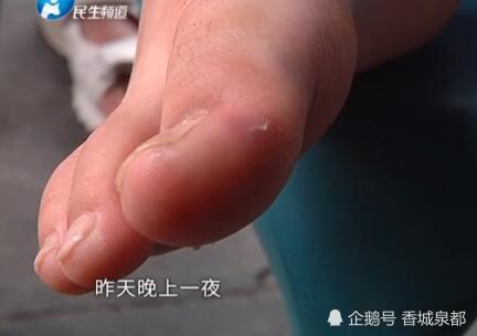 吓坏!女童街头被老鼠咬了一口脚趾,没几步老鼠当场死亡,妈妈吓出冷汗